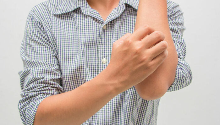 Everything to know about eczema
