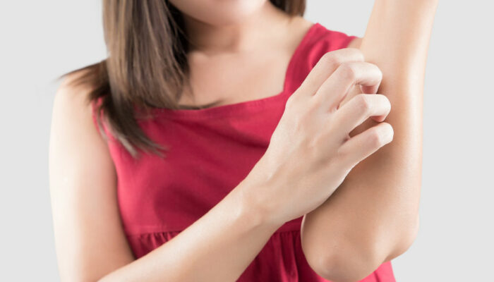 Managing dermatitis – 11 remedies for itchy skin