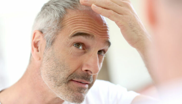 8 Medical Conditions That May Cause Severe Hair Loss