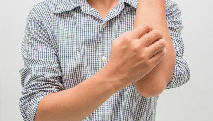 Eczema – Signs, Symptoms, and Home Remedies
