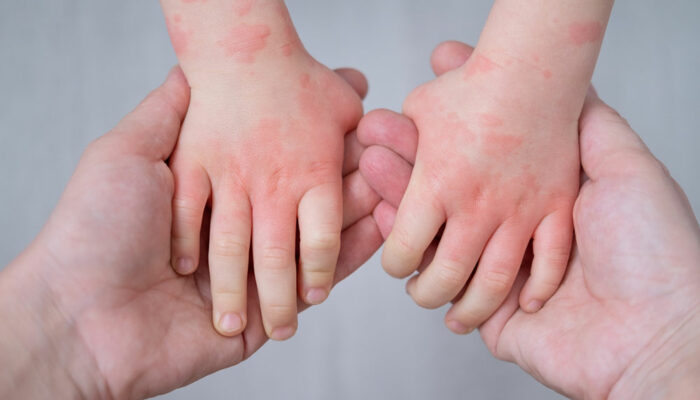 Atopic dermatitis management in children