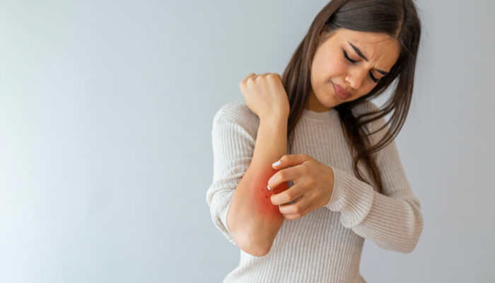 10 signs of developing psoriasis